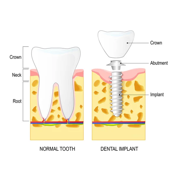 Zahnimplantat und normaler Zahn — Stockvektor