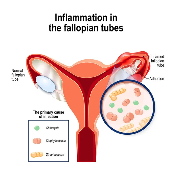 Inflamación en las trompas de Falopio. causa primaria de infección — Vector de stock