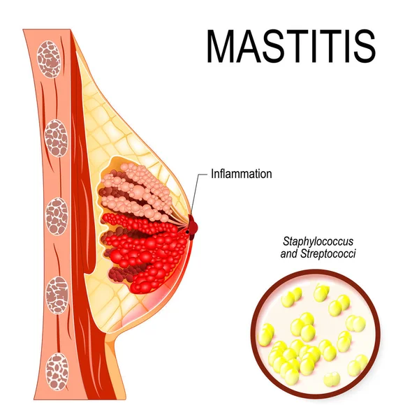Μαστίτιδα. φλεγμονή του μαστού (σχηματισμός αποστήματος). — Διανυσματικό Αρχείο