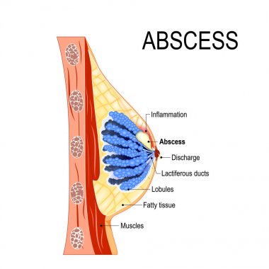 abscess. Cross-section of the mammary gland with inflammation clipart