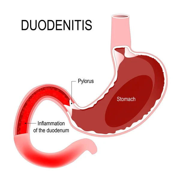 Duodenite. Stomaco e duodeno con infiammazione. Anatomo umano — Vettoriale Stock