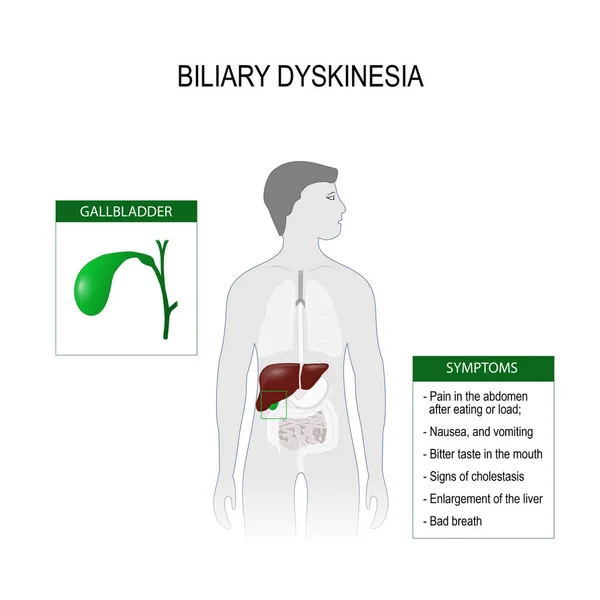 Dyskinésie biliaire — Image vectorielle