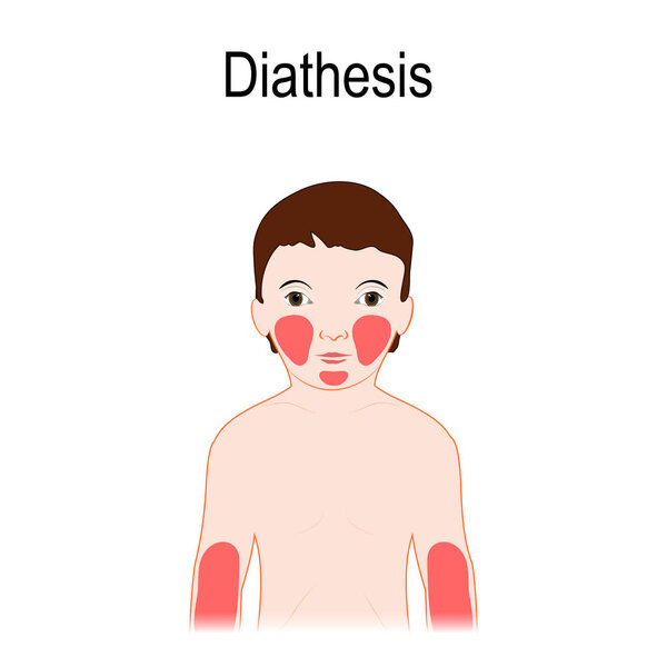 Diathesis. Atopic dermatitis (atopic eczema). Location on a huma
