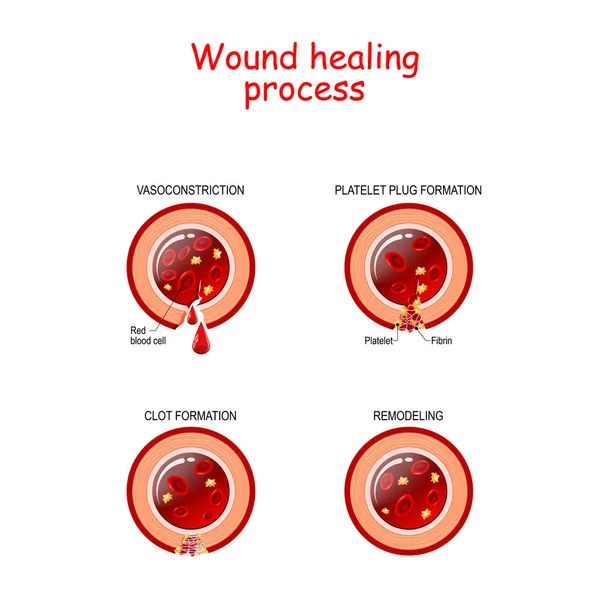 Faser av sårläkningsprocessen. affisch med kapillär, röd — Stock vektor