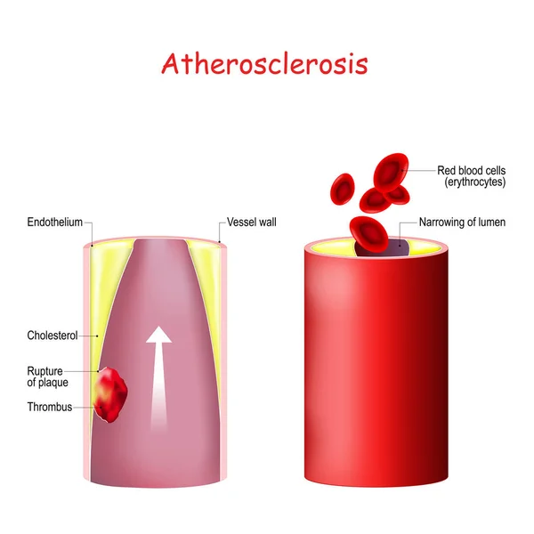 Colesterolo. Formazione di trombi in un vaso aterosclerotico — Vettoriale Stock