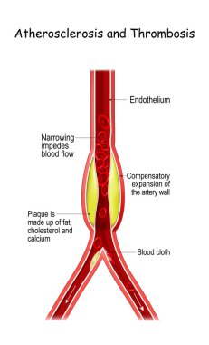 Atherosclerosis and Thrombosis clipart