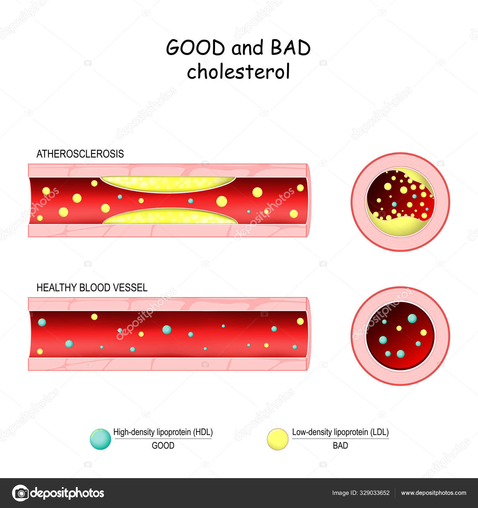 Good (HDL) and bad (LDL) cholesterol. Healthy blood vessel and A Stock Vector by ©edesignua