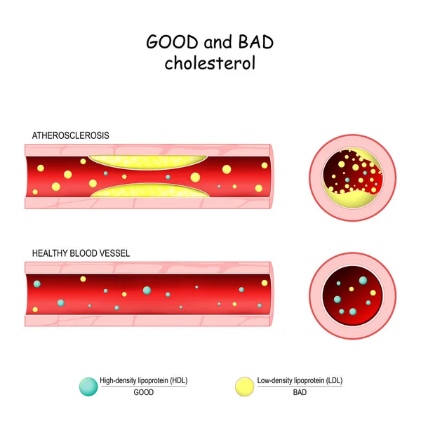 Good (HDL) and bad (LDL) cholesterol. Healthy blood vessel and A — ストックベクタ