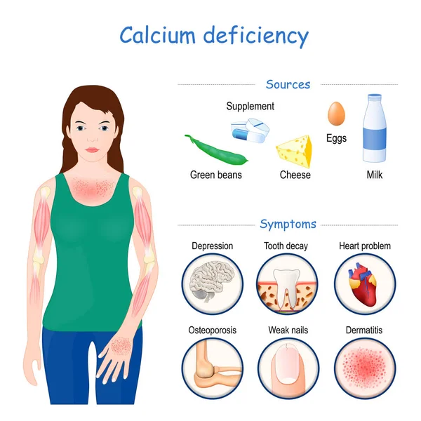 Deficiencia de calcio. Signo, síntomas y fuentes — Archivo Imágenes Vectoriales