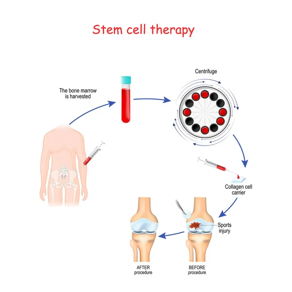 Stamceltherapie Voor Sportblessure Menselijk Kniegewricht — Stockvector