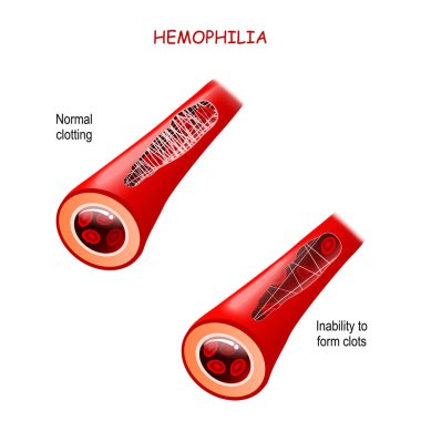 Hemofili. Hemofili. Kanamadan sonra sağlıklı kan damarı ve pıhtılaşma bozukluğu olan kan damarı. Pıhtı oluşturamamak. Kan pıhtısı oluşumu. Tıbbi bilgilerle ilgili gerçekler. Poster.