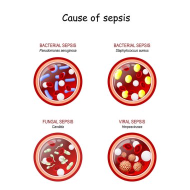 Sepsis yüzünden. Mantar (candida) viral (herpes) bakteriyel (staphylococcus aureus, pseudomonas aeruginosa). Kırmızı kan hücreleri, lökositler ve enfeksiyonlu kan damarlarının yakın çekimleri. Vektör çizimi. Kanlı mikrop