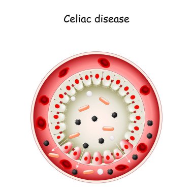 Celiac disease. Cross section of Small intestine lining damage. good and damaged villi. leaky gut. Coeliac (sprue) disease: an autoimmune disorder against gluten (gliadin). cells on gut lining held tightly together. Vector diagram