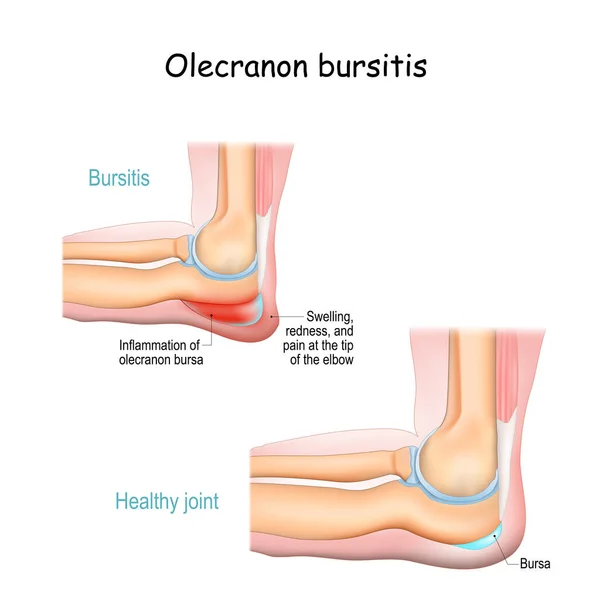 Olecranon Bursitis 学生の肘 健康状態 肘Olecranonの下に位置するブルサの炎症 外傷や反復性の小さい外傷です 肘関節の解剖学 腕の一部 骨筋肉やトリップの遠位腱 ベクトル — ストックベクタ