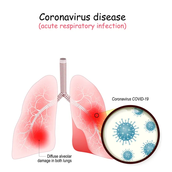Paru Paru Manusia Diserang Oleh Coronavirus Sindrom Pernapasan Timur Tengah - Stok Vektor