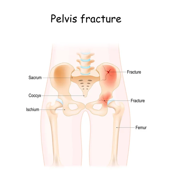 Fracture Bassin Pelviens Sacrum Ilium Coccyx Pubis Ischium Fémur Illustration — Image vectorielle