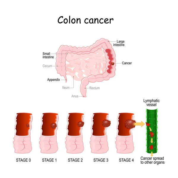 Cancro Colon Oncologia Colorettale Sviluppo Tumore Maligno Fasi Diagramma Medico — Vettoriale Stock