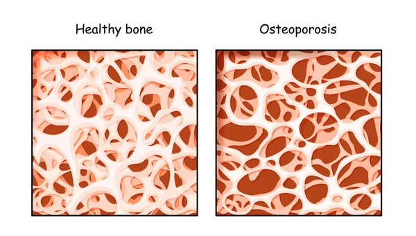 Friska Ben Och Osteoporos Jämförelse Isolerad Vit Bakgrund Skelettsjukdom Som — Stock vektor
