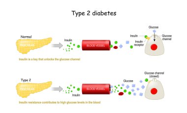 Tip 2 diyabet Mellitus. Diyabet ve sağlıklı bir vücuttaki hücre çalışmalarının karşılaştırılması. İnsülin direnci kanda yüksek glikoz seviyesine yol açar. İnsülin glikoz kanalını açan bir anahtardır. Bilgisel. Vektör illüstrasyonu