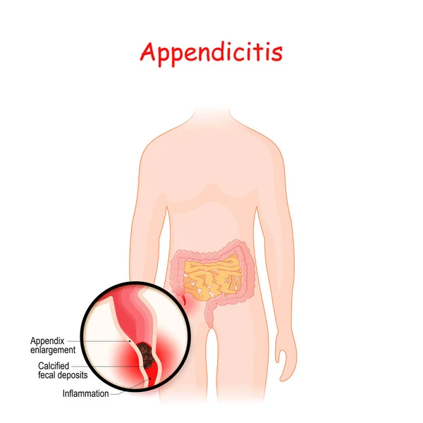 Zapalenie Wyrostka Zbliżenie Wyrostka Robaczkowego Zapaleniem Ilustracja Wektora Diagram Anatomiczny — Wektor stockowy