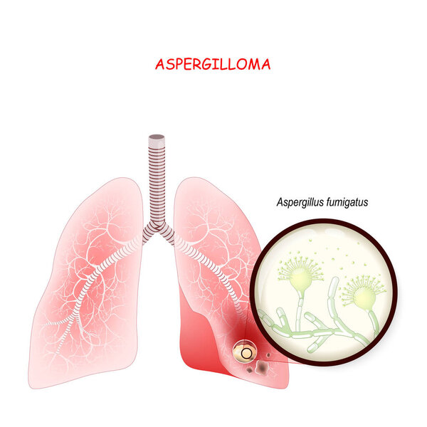 Aspergilloma is a clump of mold which exists in a body cavity. Human's lungs with fungi. Close up of Aspergillus fumigatus. Vector illustration for medical use