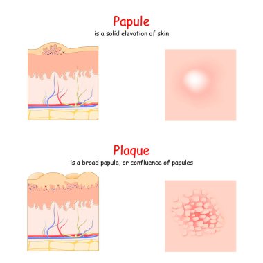 Skin lesion. Papule and Plaque. side and top view. Cross section of the human skin. Papule is a solid elevation of skin. Plaque is a broad papule. clipart