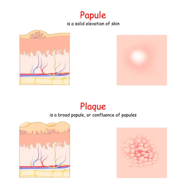 Lésion Cutanée Papule Plaque Vue Latérale Supérieure Coupe Transversale Peau — Image vectorielle