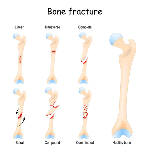Типичные переломы костей: линейные, поперечные, полные, составные, спиральные и оскольчатые. Здоровый перелом бедра и ноги на разных стадиях
. 