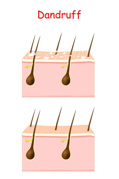 治療前と治療後の髪の毛の擦れ 脂漏性皮膚炎は 頭皮の乾燥肌 細菌や真菌のために発生する可能性があります 乾燥した皮膚フレークの形成を引き起こします ポスター バナー 美容クリニック 化粧品やスキンケアの使用のためのベクトルイラスト — ストックベクタ