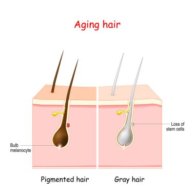 aging process through gray hair. Pigmanted and gray hair. The stem cells at the hair follicles produce melanocytes, that produce and store pigment. The death of the melanocyte stem cells causes the onset of graying. clipart