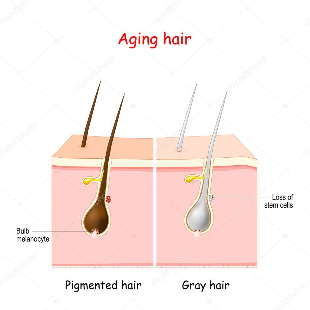 aging process through gray hair. Pigmanted and gray hair. The stem cells at the hair follicles produce melanocytes, that produce and store pigment. The death of the melanocyte stem cells causes the onset of graying.