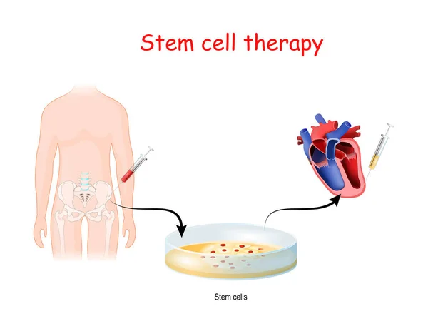 Stamceltherapie Van Pelvis Naar Hart Vectordiagram Voor Medisch Wetenschappelijk Gebruik — Stockvector