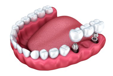 3D alt dişler ve diş implant üzerine beyaz izole. 3D render