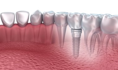 3D Render: alt dişler ve diş implantı şeffaf render üzerinde beyaz izole
