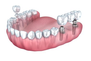 3D Render: alt dişler ve diş implantı şeffaf render üzerinde beyaz izole