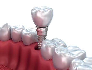 Diş implantı, tıbben doğru 3d çizim 