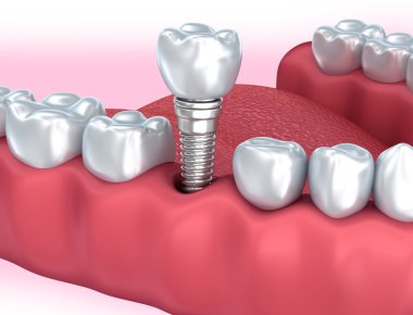 İnsan diş implantı, tıbben doğru 3d çizim 