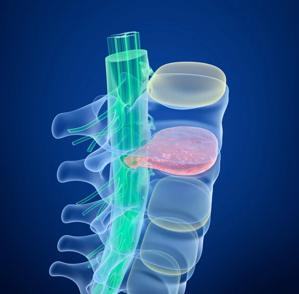 Medula espinhal sob pressão de disco abaulado, visão raio-X. Renderização 3D — Fotografia de Stock