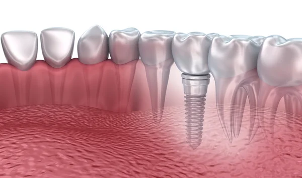 Renderização 3D: dentes inferiores e implante dentário transparente tornam-se isolados em branco — Fotografia de Stock