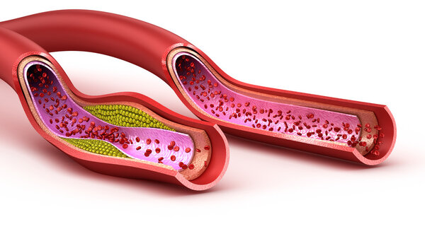 Blood vessel : normal and cholesterol damaged vessel . 3D render