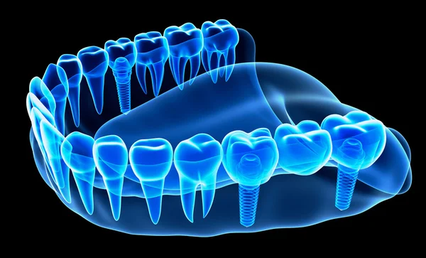 インプラントと義歯の x 線表示 — ストック写真