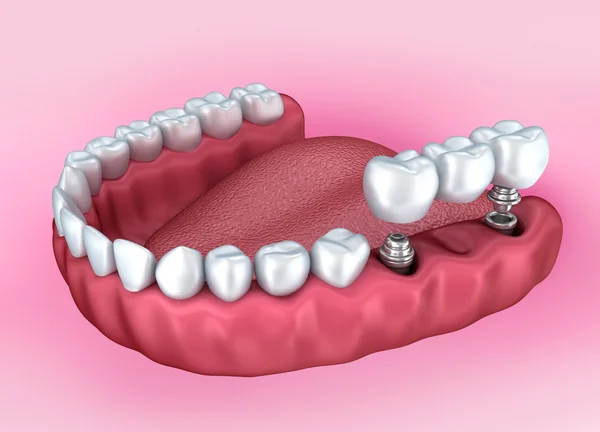 Χαμηλότερα δόντια και οδοντικό εμφύτευμα απομονωμένα σε λευκό. Ιατρικώς ακριβή 3d απεικόνιση — Φωτογραφία Αρχείου