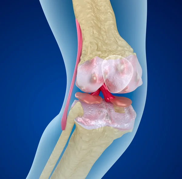 Osteoporosis de la articulación de la rodilla, ilustración 3D médicamente precisa — Foto de Stock