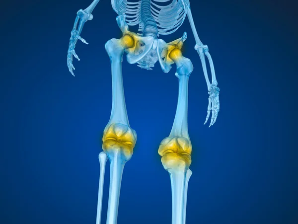 Esqueleto humano e articulações danificadas. Ilustração 3D medicamente precisa — Fotografia de Stock