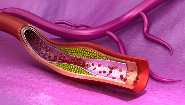 Placa de colesterol no vaso sanguíneo, ilustração 3D medicamente precisa — Fotografia de Stock