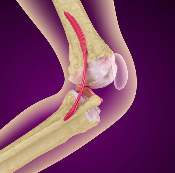 Osteoporosi dell'articolazione del ginocchio, Illustrazione 3D clinicamente accurata — Foto Stock