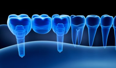 X-Ray görüş ile takma diş implantı. Xray görünümü. Tıbben doğru 3d çizim  