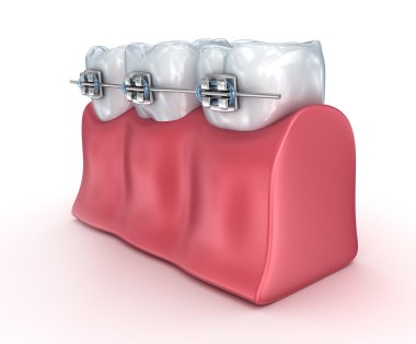Diş telleri üzerinde beyaz izole dişli. Tıbben doğru 3d çizim 