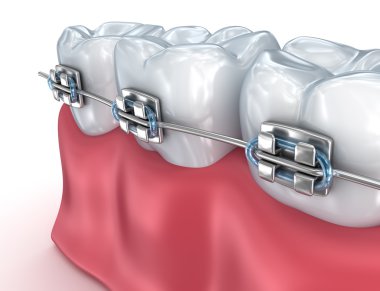 Diş telleri üzerinde beyaz izole dişli. Tıbben doğru 3d çizim 