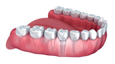 Alt dişler ve diş implantı şeffaf izole üzerinde beyaz render. 3D çizim